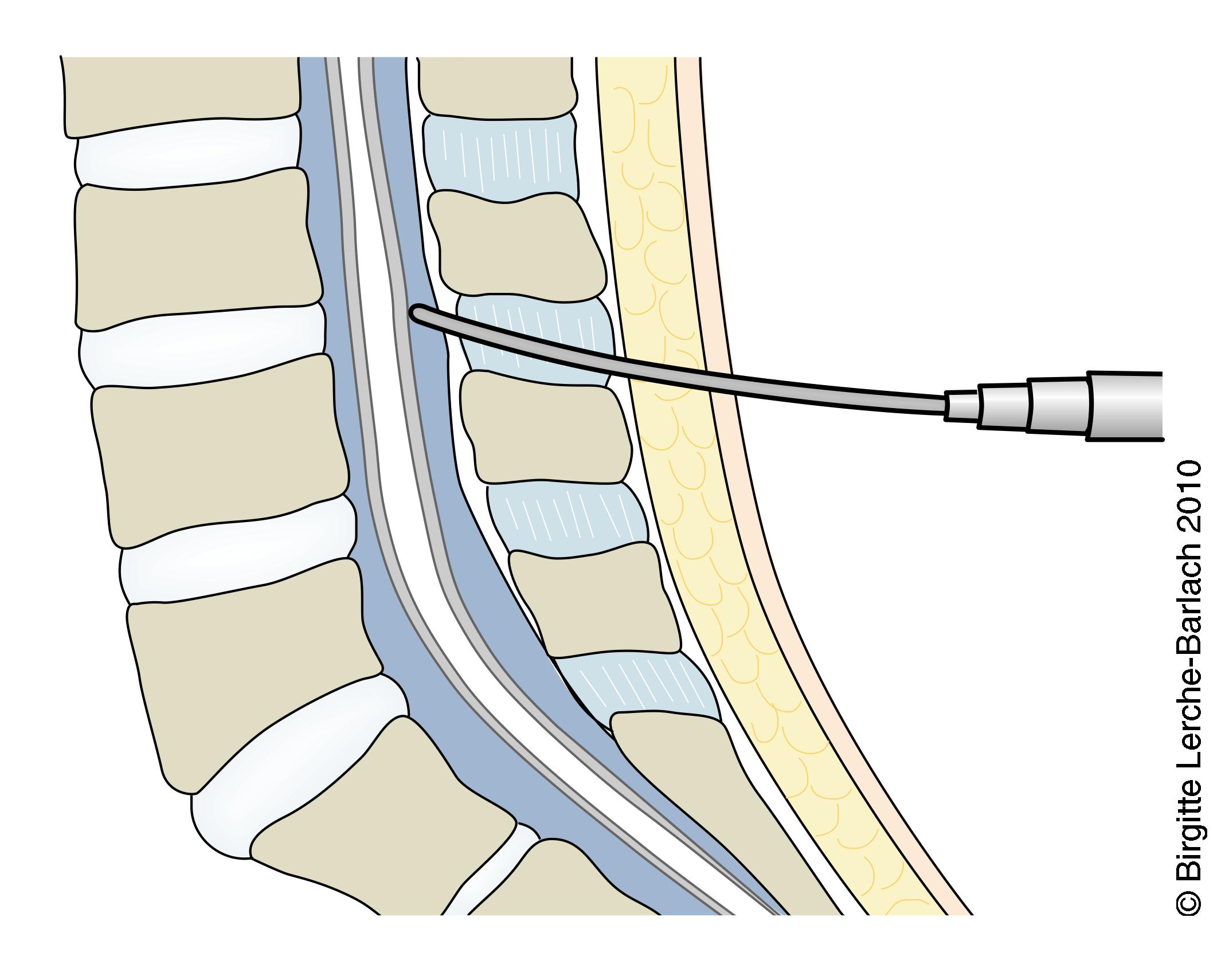 Spinalbedøvelse - Patienthåndbogen På Sundhed.dk