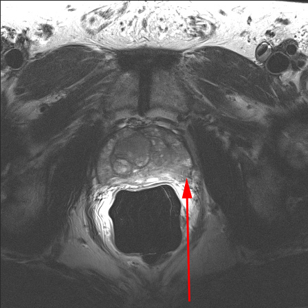 prosztata mr