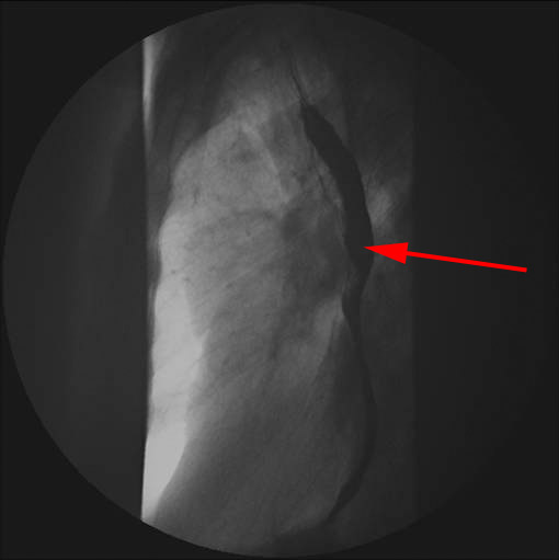 Øsofagus, normal, røntgen - Lægehåndbogen på sundhed.dk