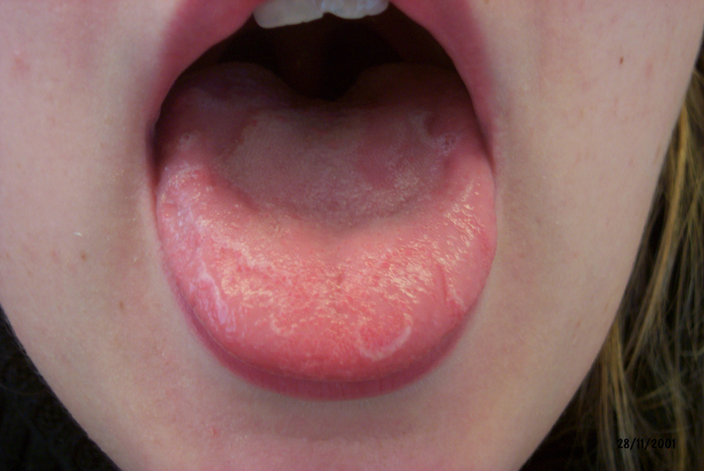 Hvide knopper på tungen