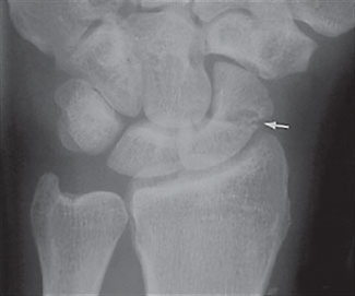 lichid în articulația genunchiului cum se tratează unguentele deteriorarea capsulei articulare a articulației umărului