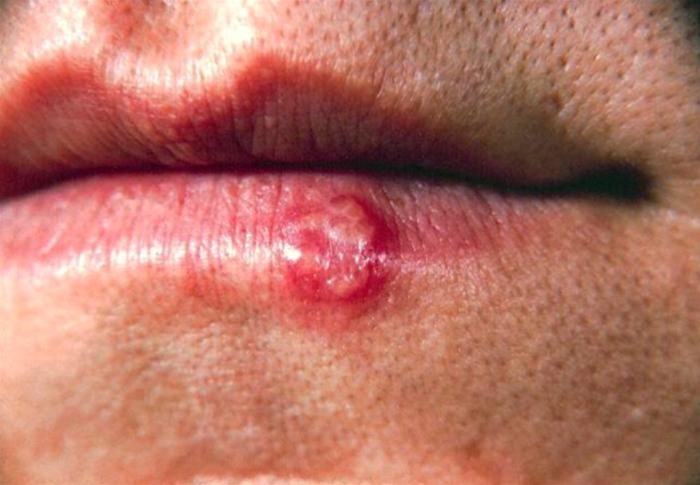 Sår på læben ikke forkølelsessår