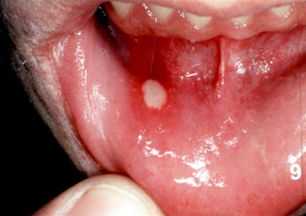 Ikke forkølelsessår sår på læben 💊 Forkølelsessår