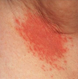 Svampeinfektion hud