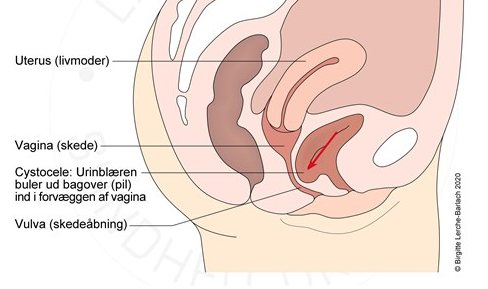 Nedsunken livmoder - Patienthåndbogen på
