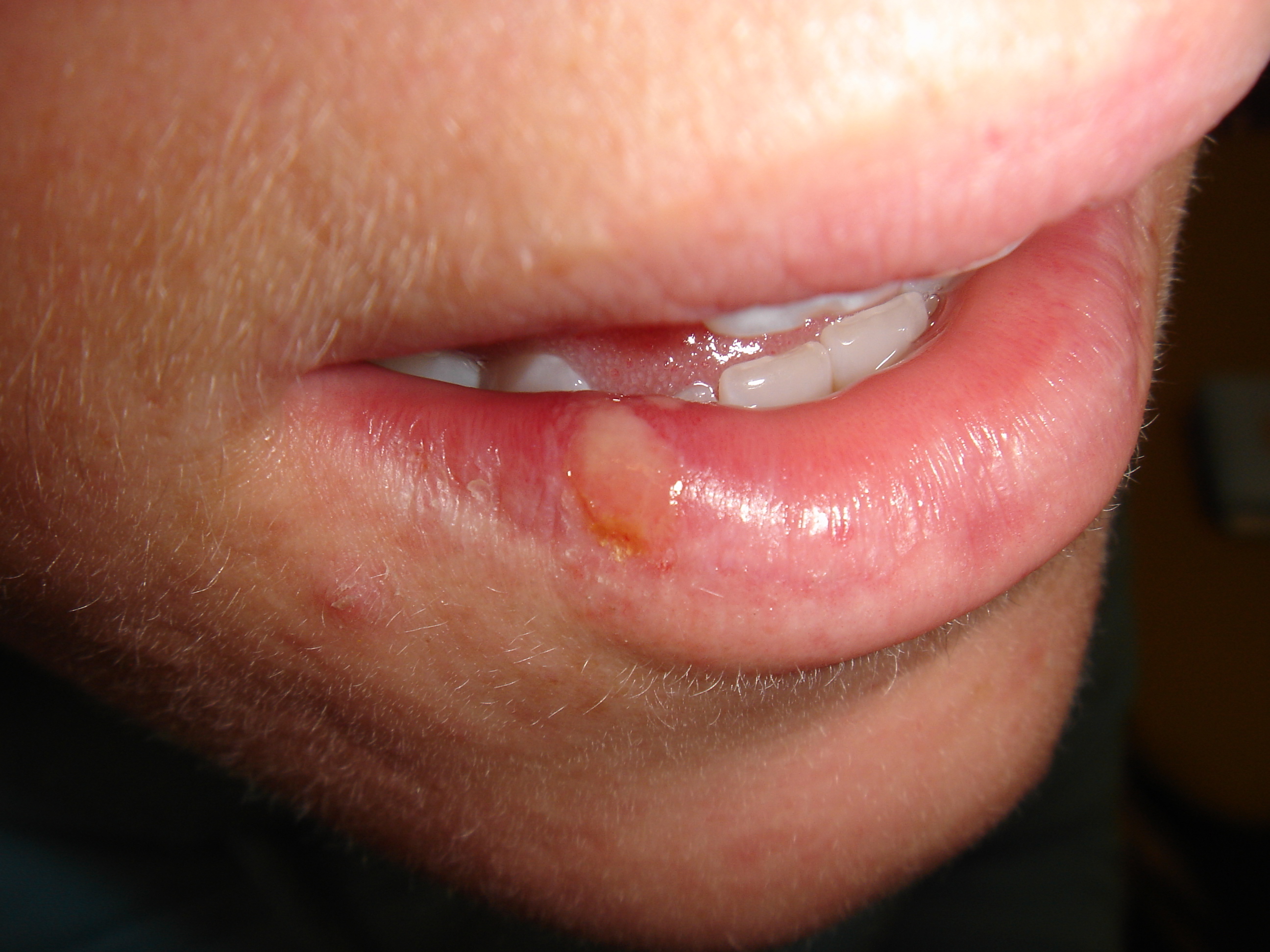 Læben ikke forkølelsessår sår på Forkølelsessår i