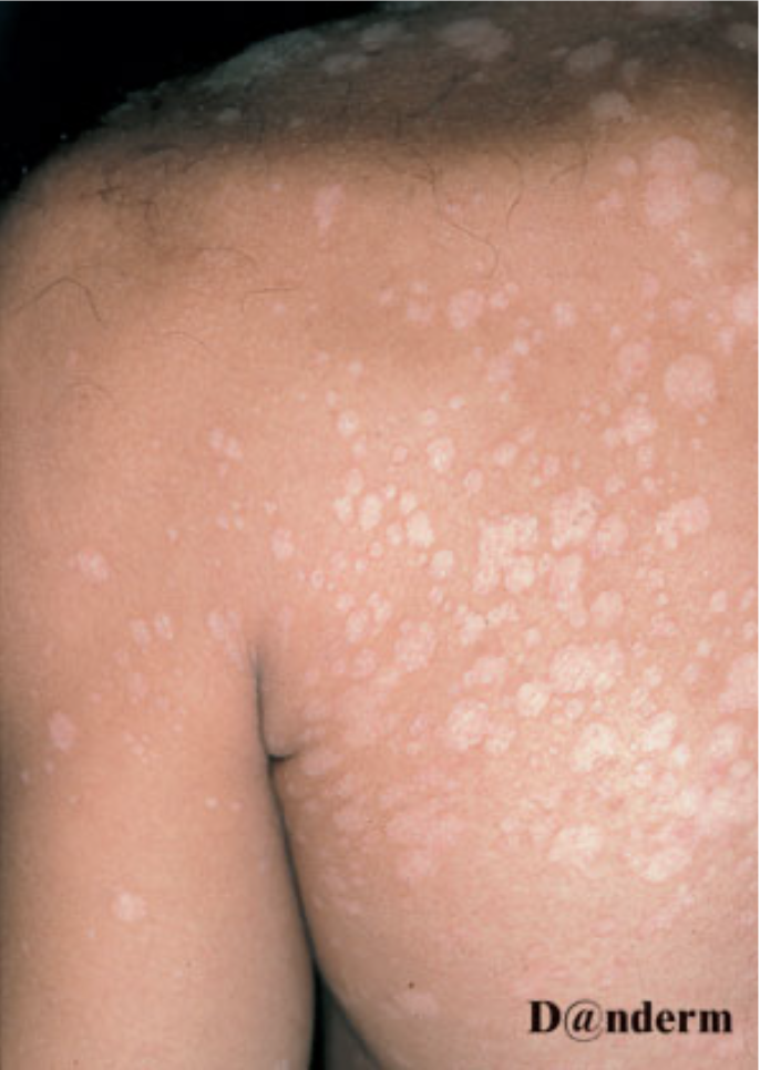 Huden behandling i svamp Hudsvamp